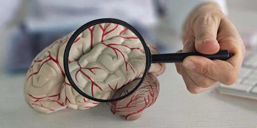 AVC silencioso pode passar despercebido e aumentar o risco de demência, alertam especialistas