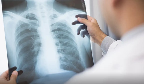 Anvisa aprova medicamento para câncer de pulmão avançado e novo tratamento para câncer de mama
